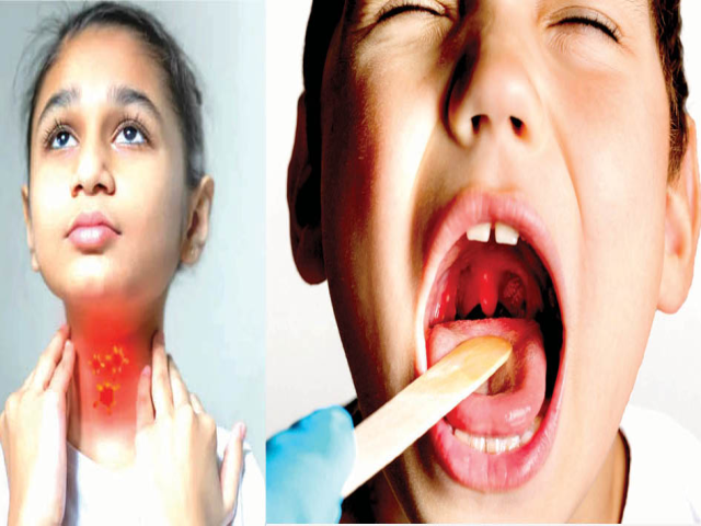 टॉन्सिल्स: घशातले छोटे सैनिक