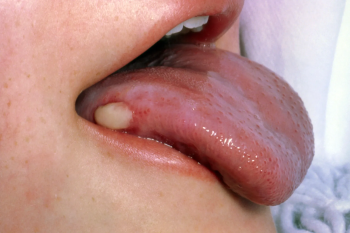 THE HEALTHY GOAN | Rising threat of oral cancer in Goa and how you can spot it early
